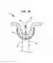 Fig. 12 - Mitral valve leaflet clip