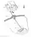 Fig. 06 - Surgical instrument for dispensing tacks and solution