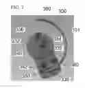 Fig. 14 - Means and methods for suturing tissue