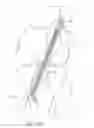 Fig. 10 - Method for implanting soft tissue