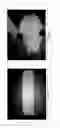 Fig. 04 - Absorbable synthetic braided matrix for breast reconstruction and hernia repair