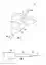 Fig. 02 - Hernia mesh placement system and method for in-situ surgical applications