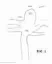 Fig. 02 - Shape-memory polymer foam device for treating aneurysms