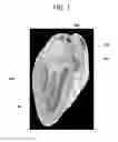 Fig. 02 - Devices and methods for excluding the left atrial appendage