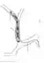 Fig. 197 - Methods of embolic filtering