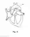 Fig. 07 - Medical occlusion device