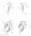 Fig. 02 - Pedicle-based construct facet joint fixation device