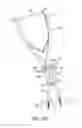 Fig. 12 - Fulcrum cap for spinal constructs