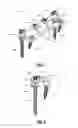 Fig. 02 - Systems and methods for spinal compression, distraction, and fixation