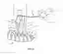 Fig. 12 - Surgical implant system and method