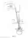 Fig. 13 - Surgical implant system and method