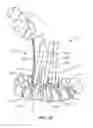 Fig. 16 - Surgical implant system and method