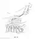 Fig. 17 - Surgical implant system and method