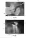 Fig. 02 - Surgical fastening