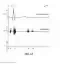 Fig. 06 - Estimating electromechanical delay to optimize pacing parameters in RBBB patients