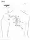 Fig. 02 - Modulate pacing rate to increase the percentage of effective ventricular capture during atrial fibrillation