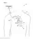 Fig. 02 - MODULATE PACING RATE TO INCREASE THE PERCENTAGE OF EFFECTIVE VENTRICULAR CAPTURE DURING ATRIAL FIBRILLATION