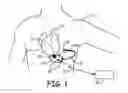 Fig. 02 - Subthreshold lead impedance measurement for subcutaneous device