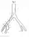 Fig. 06 - Pre-loaded iliac branch device and methods of deployment