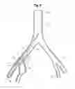 Fig. 07 - Pre-loaded iliac branch device and methods of deployment