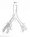 Fig. 08 - Pre-loaded iliac branch device and methods of deployment