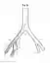 Fig. 09 - Pre-loaded iliac branch device and methods of deployment