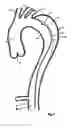 Fig. 02 - Device and method for treating vascular dissections