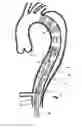 Fig. 09 - Device and method for treating vascular dissections