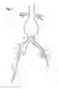 Fig. 04 - Extension for iliac branch delivery device and methods of using the same