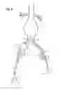 Fig. 06 - Extension for iliac branch delivery device and methods of using the same