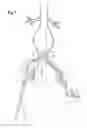 Fig. 08 - Extension for iliac branch delivery device and methods of using the same