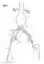 Fig. 09 - Extension for iliac branch delivery device and methods of using the same