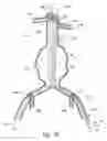 Fig. 09 - Endograft device delivery systems and associated methods