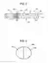 Fig. 02 - PROSTHESIS COMPRISING A COILED STENT AND METHOD OF USE THEREOF