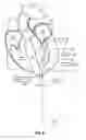 Fig. 07 - Trans-apical implant systems, implants and methods