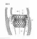 Fig. 04 - Transcatheter valve prosthesis