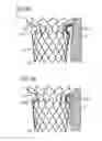 Fig. 10 - Transcatheter valve prosthesis