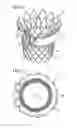 Fig. 13 - Transcatheter valve prosthesis