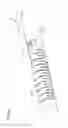Fig. 34 - Transcatheter valve prosthesis