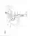 Fig. 37 - Transcatheter valve prosthesis