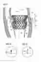 Fig. 02 - Transcatheter valve prosthesis