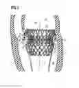 Fig. 04 - Transcatheter valve prosthesis