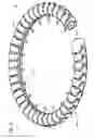 Fig. 32 - Transcatheter valve prosthesis