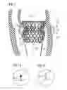 Fig. 02 - Transcatheter valve prosthesis