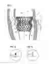 Fig. 02 - Transcatheter valve prosthesis