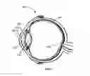 Fig. 02 - Micro-incision IOL and positioning of the IOL in the eye