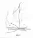 Fig. 03 - Methods of making reinforced soft grafts with suture loop/needle construct