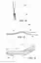 Fig. 10 - Methods of making reinforced soft grafts with suture loop/needle construct