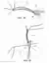 Fig. 11 - Methods of making reinforced soft grafts with suture loop/needle construct