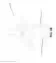 Fig. 06 - Expandable coil spinal implant